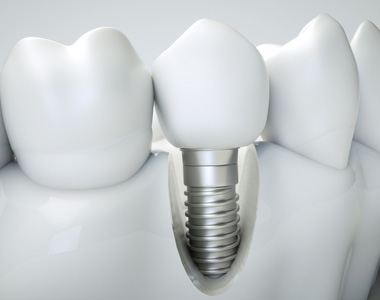 Dental-Implants