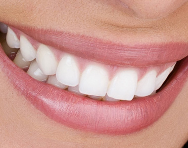 Veneers